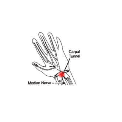 CARPAL TUNNEL GLOVES